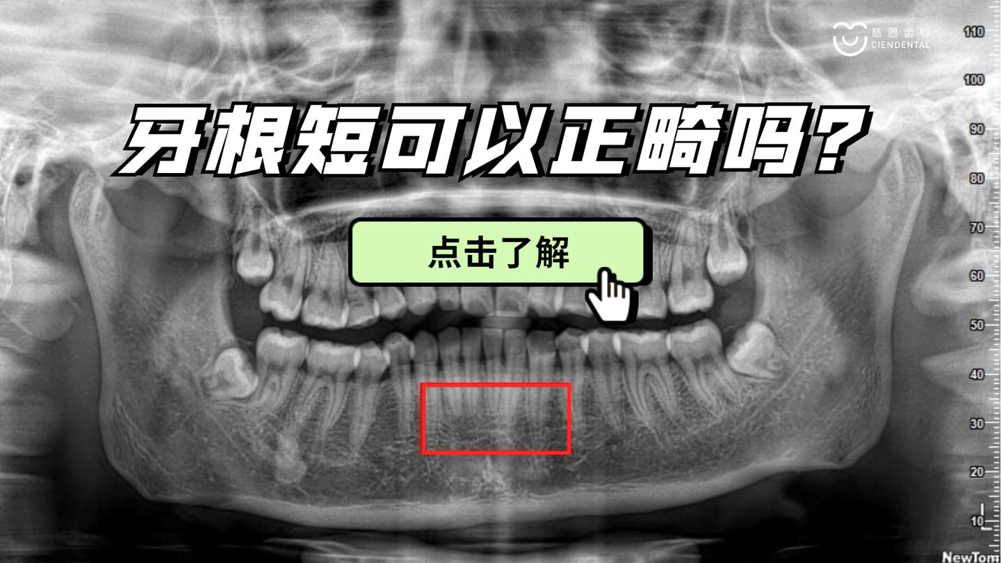 牙根短可以正畸吗
