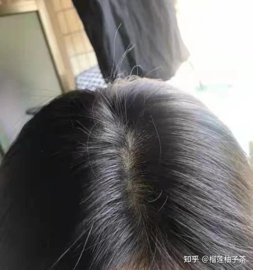 头顶秃掉发多头皮毛囊油脂超级多怎么才能减少掉发