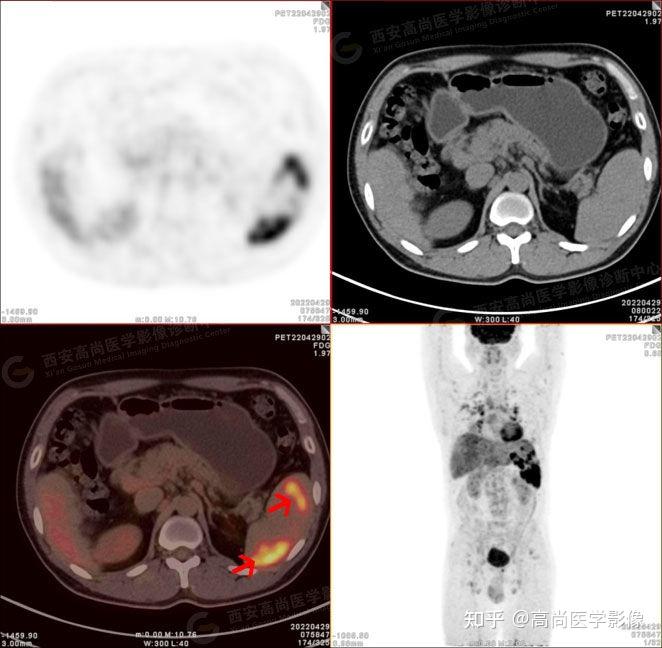18F-FDG PET/CT-MR多模态诊断结节病累及脾脏一例 - 知乎