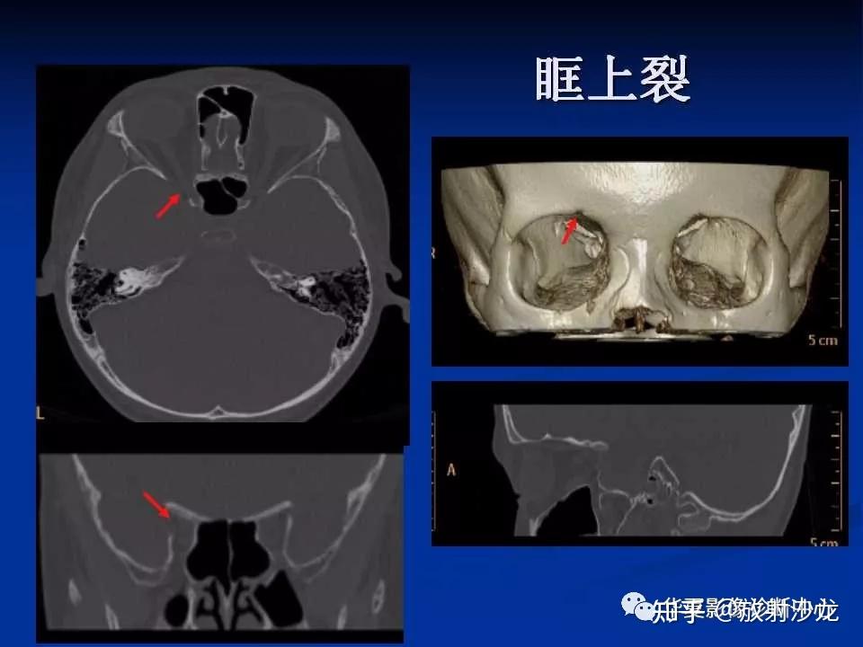 实用、详细的颅底各孔道影像解剖! - 知乎