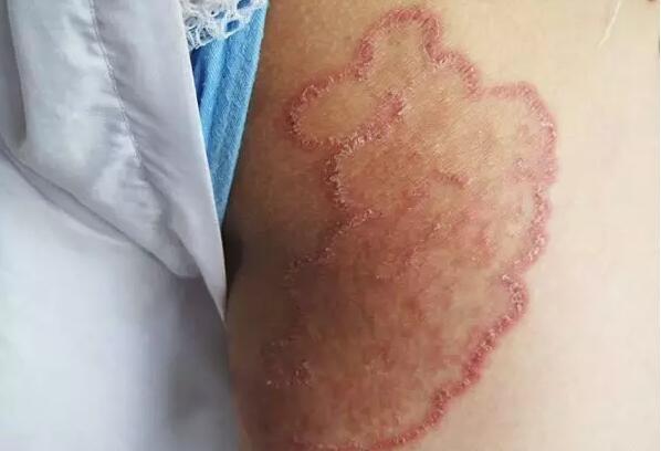 股癣怎么治两个重要外洗方让你远离痒痒痒