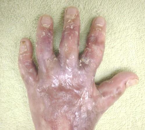 炎症反应在烧烫伤中烧烫伤疤痕挛缩的作用2身材总监烧烫伤弹力衣定制