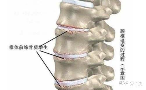 骨刺长在哪里图片图片