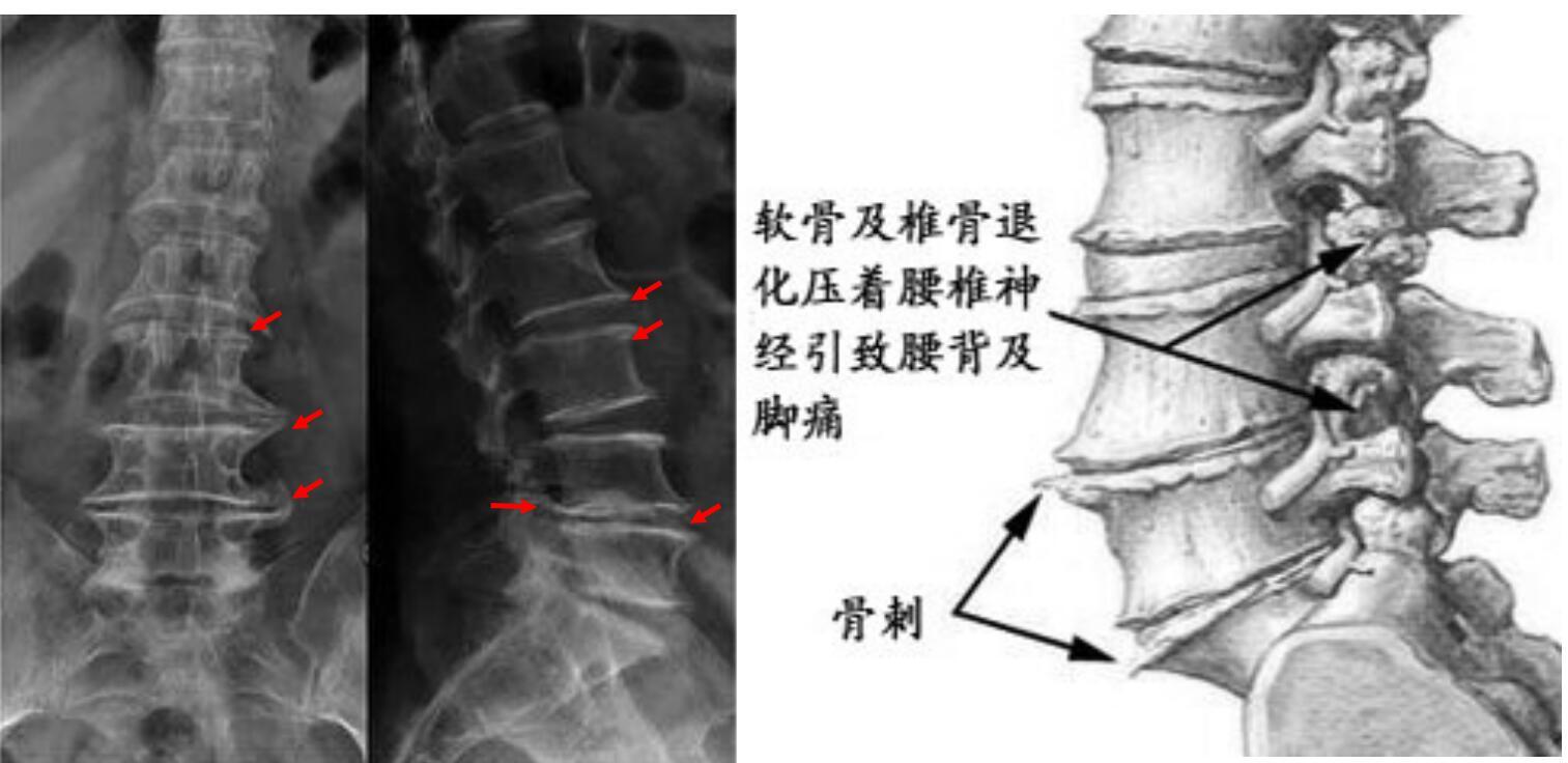 图5 腰椎骨质增生x片腰椎骨质增生:腰椎骨刺是最为常见的,超过35岁的