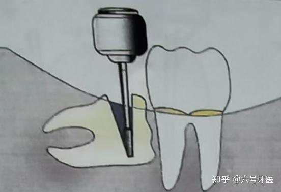口腔拔牙技巧总篇 - 知乎