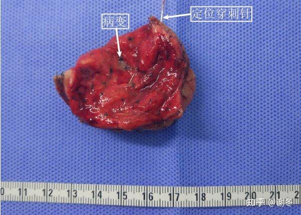 磨玻璃结节ct定位下穿刺安全吗会不会引起肿瘤播散