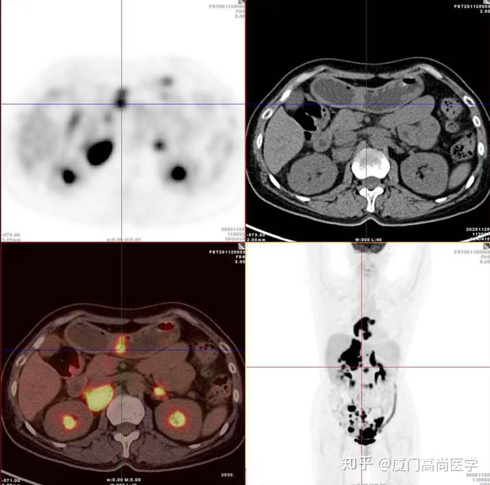 pet-ct怎么看图片