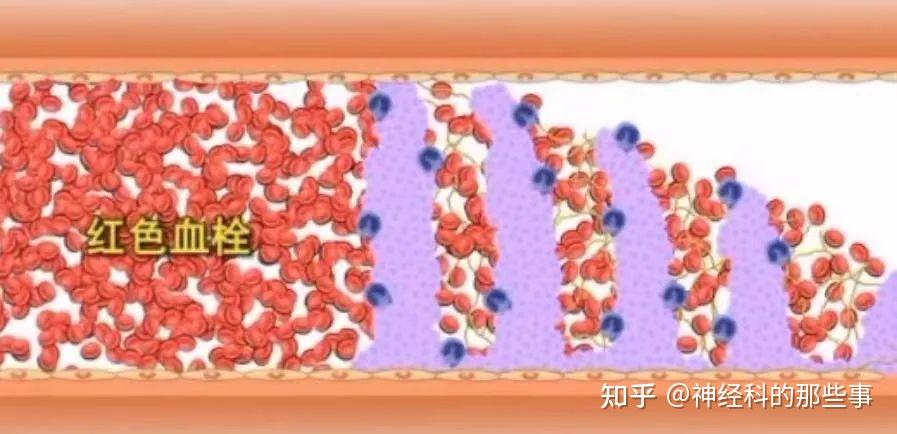 血栓形成的病理过程 - 知乎