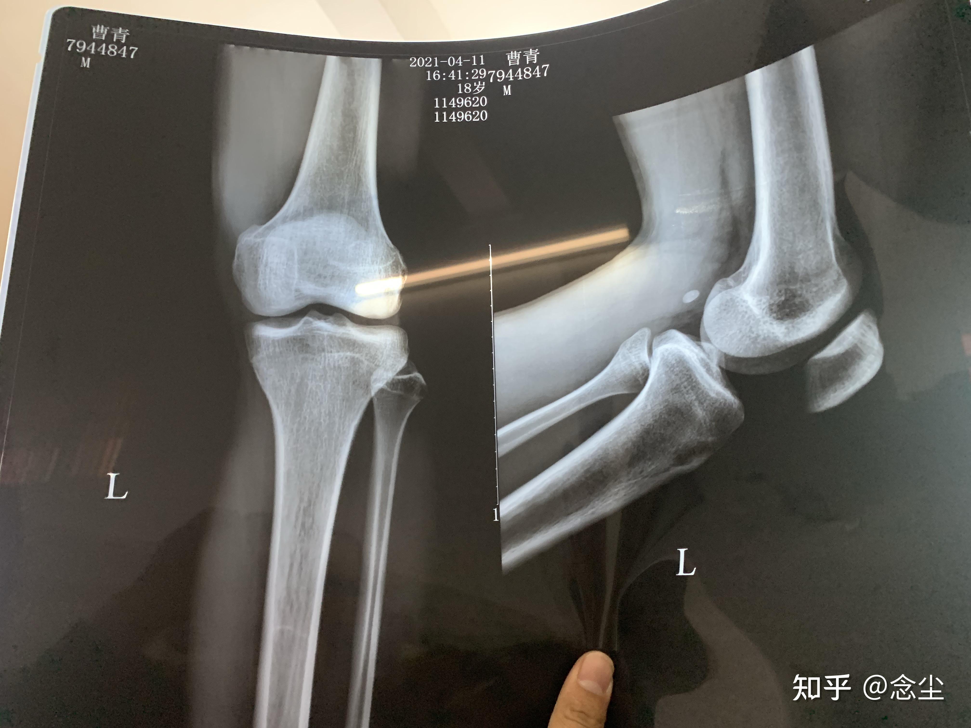 儿童膝关节骨骺图片图片