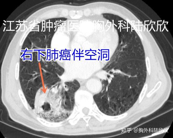 一個肺癌伴冠狀動脈支架患者的曲折住院經過