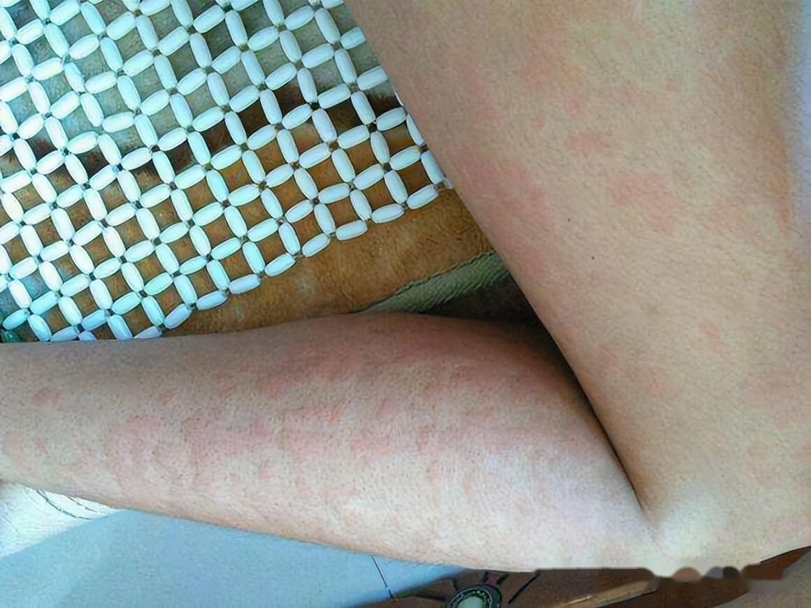 5味中药对过敏湿疹荨麻疹皮肤瘙痒皮炎妙不可言