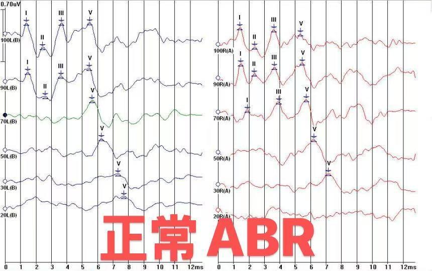 我们常说的ABR检查,你有了解吗? - 知乎