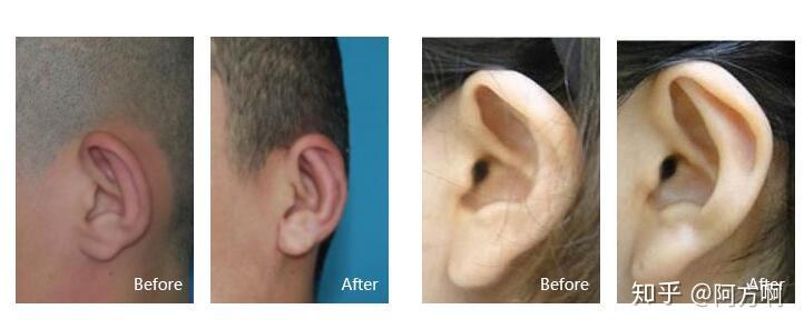 耳朵整形科普丨耳再造手术一般多少钱 知乎