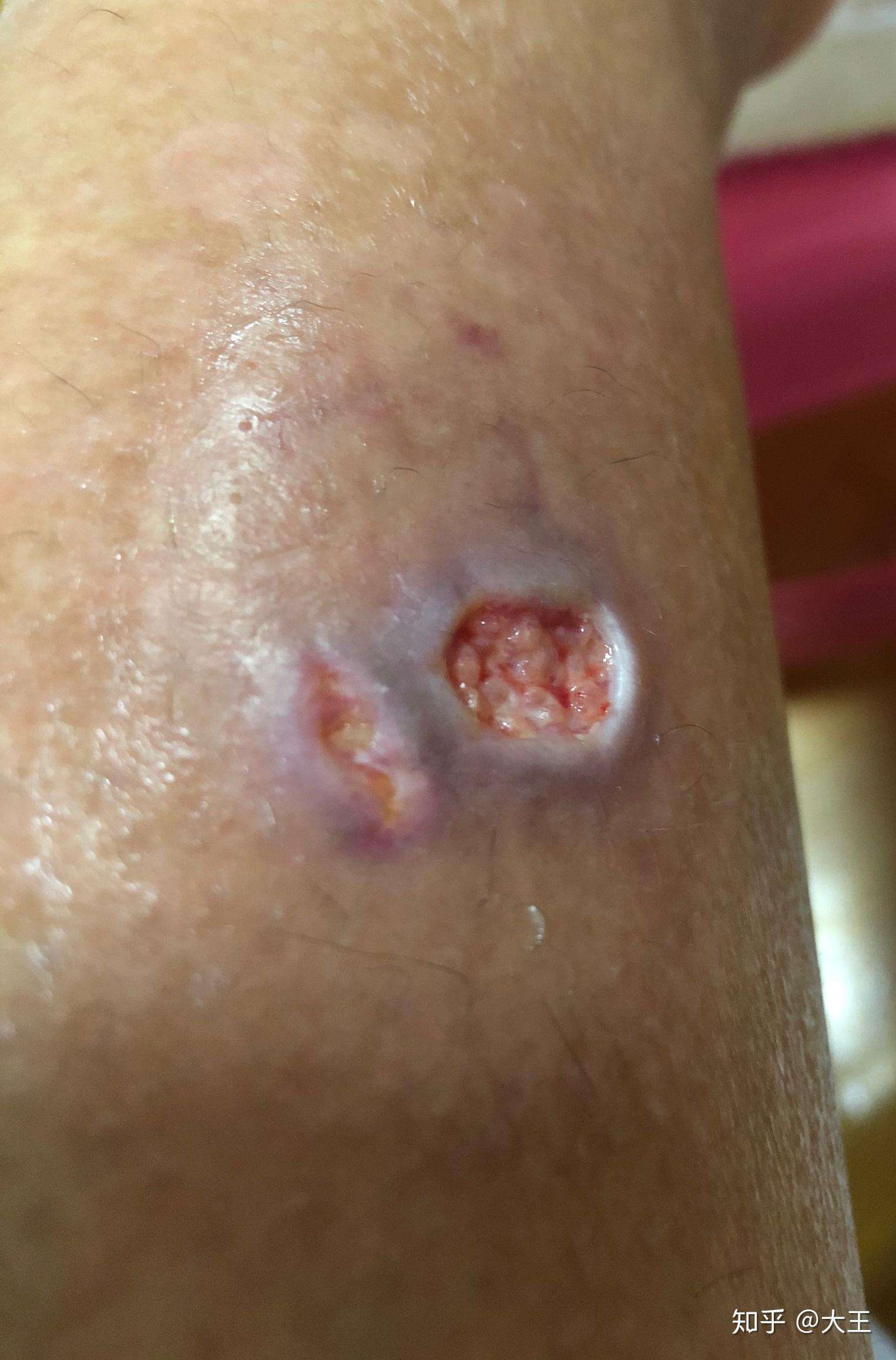 艾灸烫伤到感染起湿疹到清创恢复过程记录