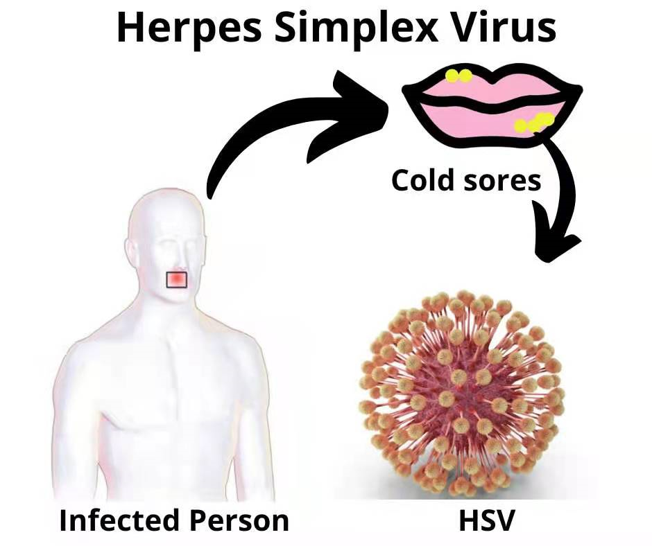 单纯疱疹,指的是单纯疱疹病毒(hsv)感染后,引发的病毒性皮肤病