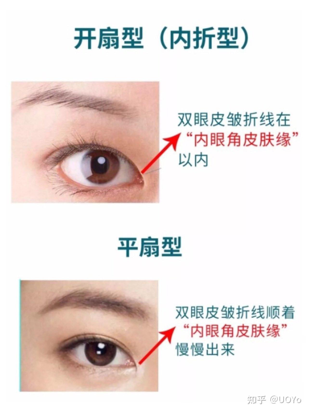 双眼皮形状分类！为什么不主张中国人做欧式平行双眼皮？ - 知乎