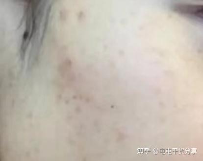 痘痘妹子必备 - 知乎