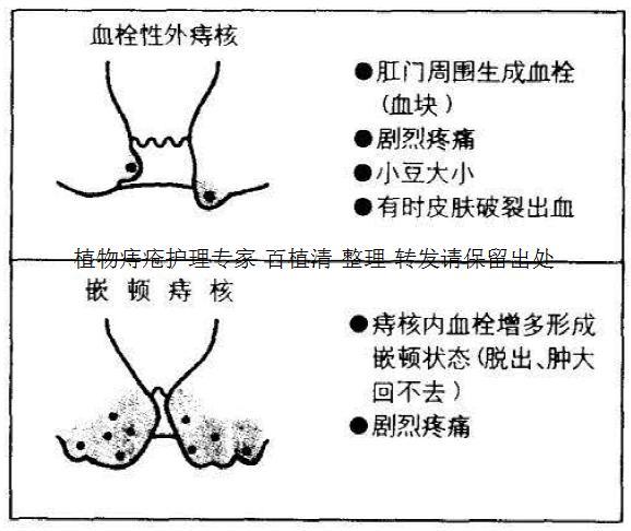 痔疮剧痛是咋回事？痔疮疼痛的最佳治疗方法是什么？收藏！转发！ - 知乎