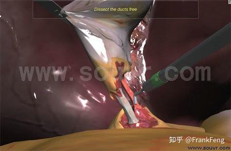 胆囊切除术模拟系统虚拟现实解决方案 知乎