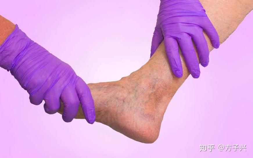 患者在日常生活中要保证充足的睡眠,减少身体对下肢的压力,以免血管