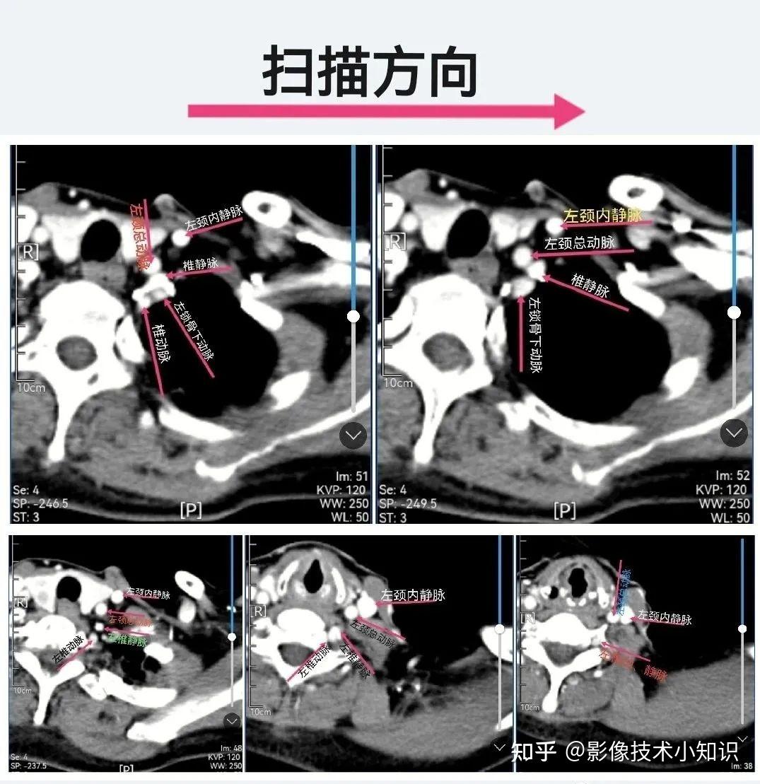 颈总动脉断层解剖图图片