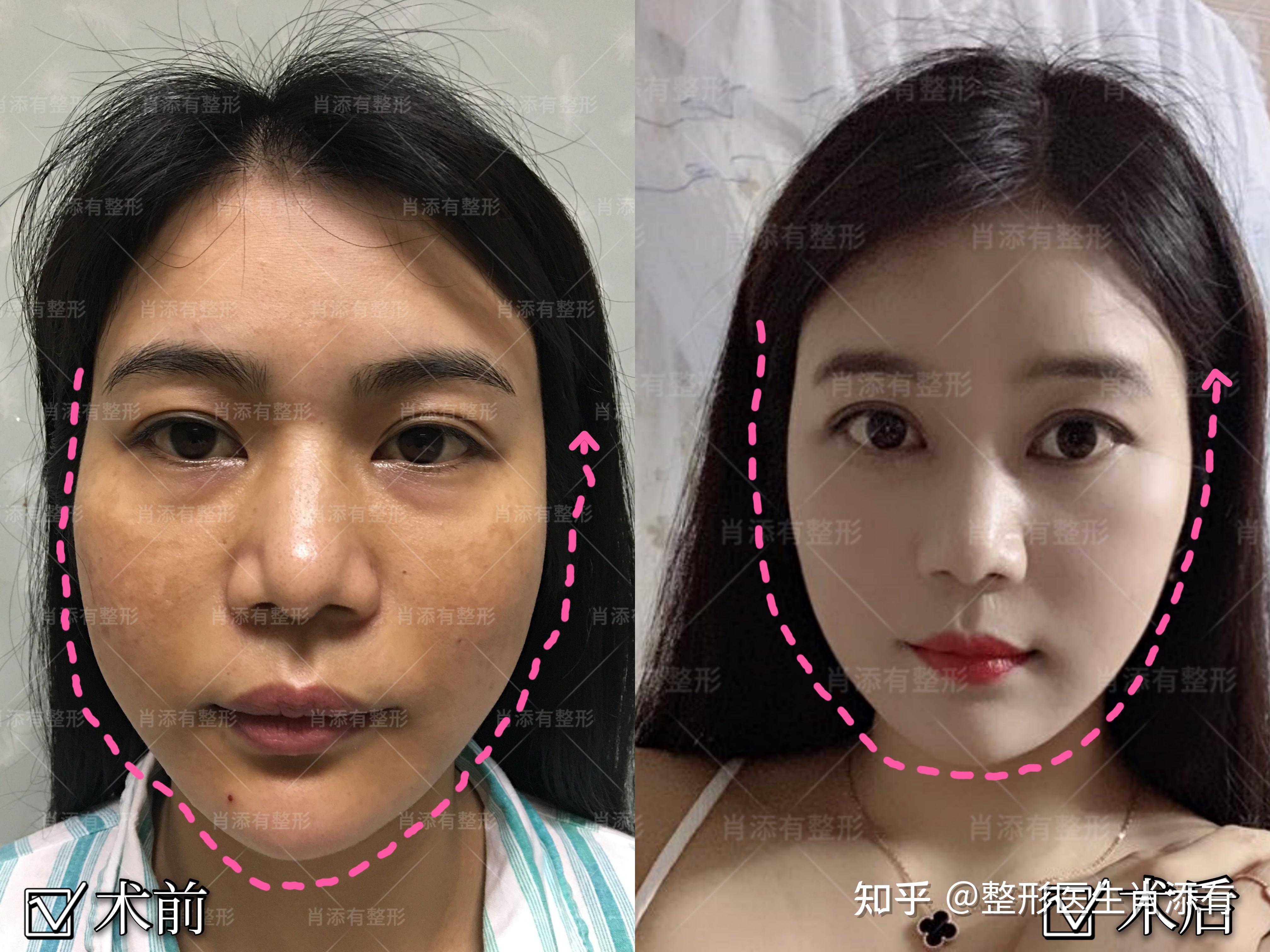 女孩33岁,面部有松弛下垂,通过面部埋线提升手术前术后对比图片. - 哔哩哔哩