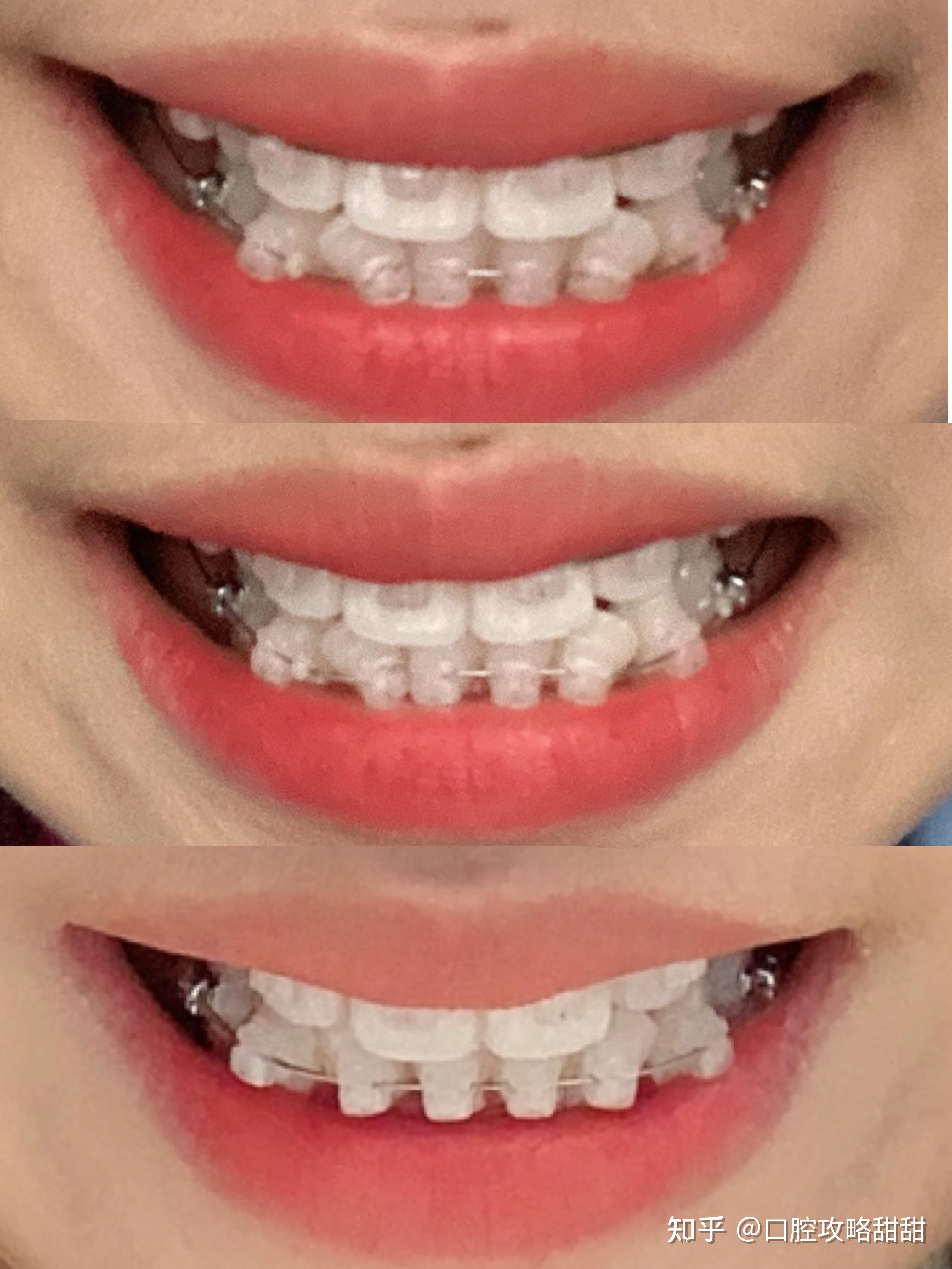 矫正牙齿的牙套有哪几种类型（矫正科普——牙套有几种类型？） | 说明书网