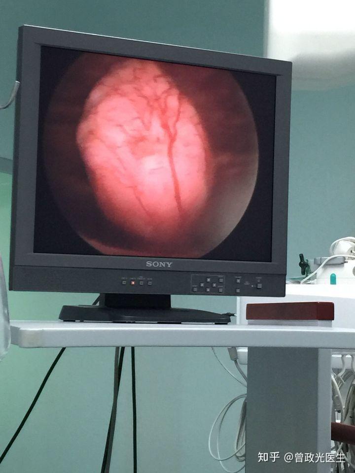 膀胱镜,是内窥镜的一种,形状与尿道探子相似,由电镜鞘,检查窥镜,处置