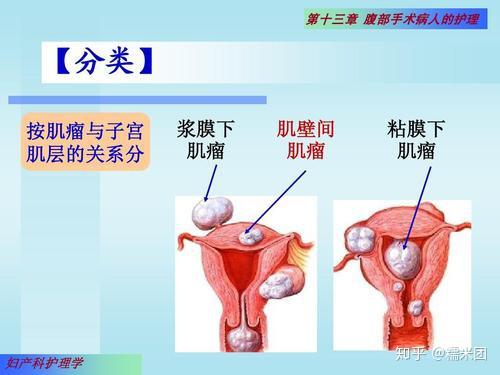 傳統的子宮肌瘤的分型,按照肌瘤與子宮壁的關係,可分為 漿膜下肌瘤