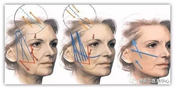 面部线雕提升原理效果好吗?面部线雕一到7天图片真不省心