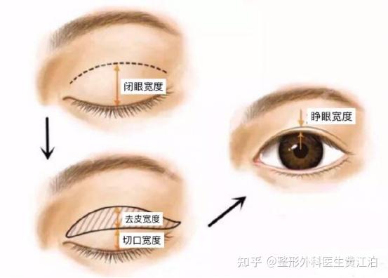 双眼皮成型的原理是将皮肤与睑板固定粘连,形成褶皱.