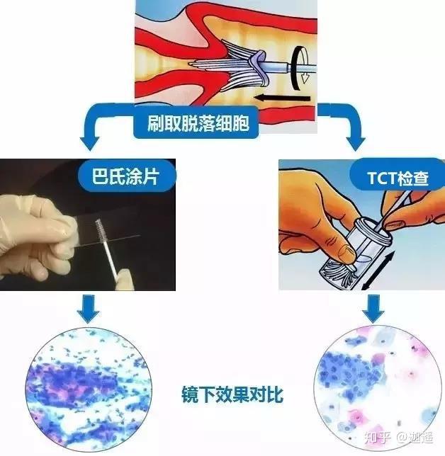 tct检查与传统的宫颈刮片"巴氏涂片"检查相比,tct检查明显提高了标本