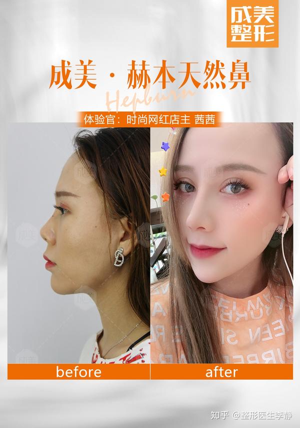 隆鼻后鼻尖红肿 是不是隆鼻失败了 知乎