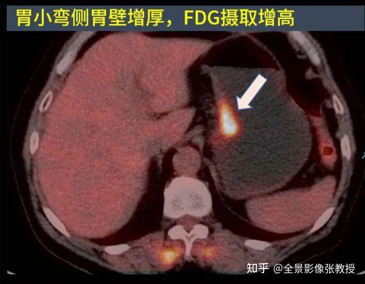 案例分享：PET/CT检查优势——快速寻找原发灶&准确确定病灶性质！ - 知乎