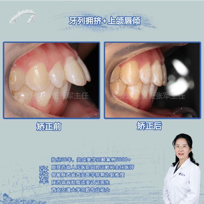 西安隱形矯正凸嘴拉垮顏值側顏正畸是不錯的選擇