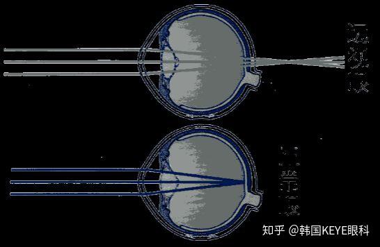 远视眼应该怎么矫正