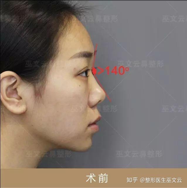 67鼻额角是由眉间点到鼻根点的线与鼻根点到鼻尖连线之间定义的角