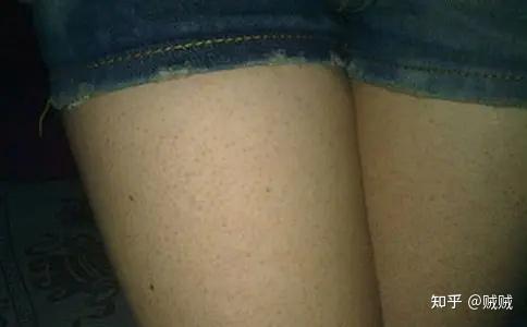 鸡皮肤的女孩子嫁出去了吗(鸡皮肤的女孩子嫁出去了吗?)
