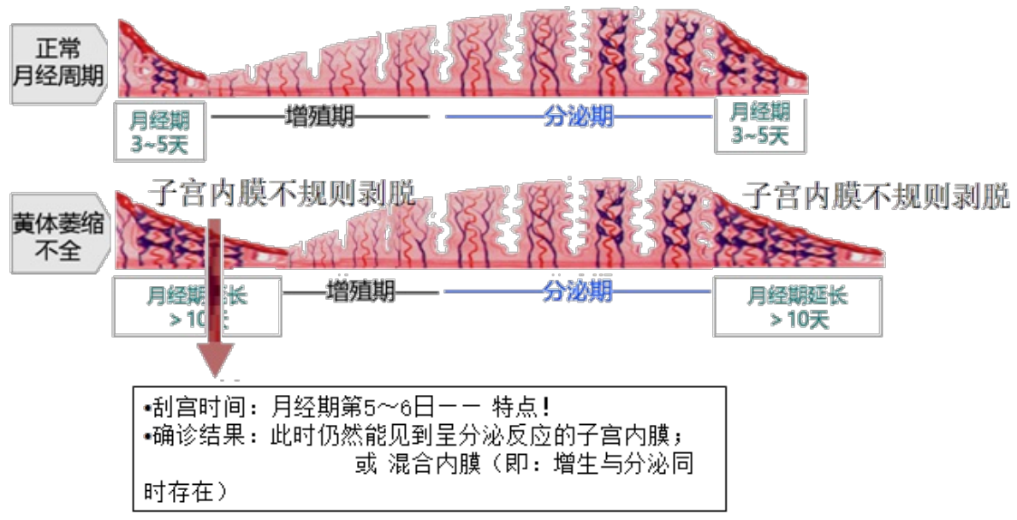 （妇产科：生殖内分泌疾病系列）其二：功能失调性子宫出血理论 - 知乎