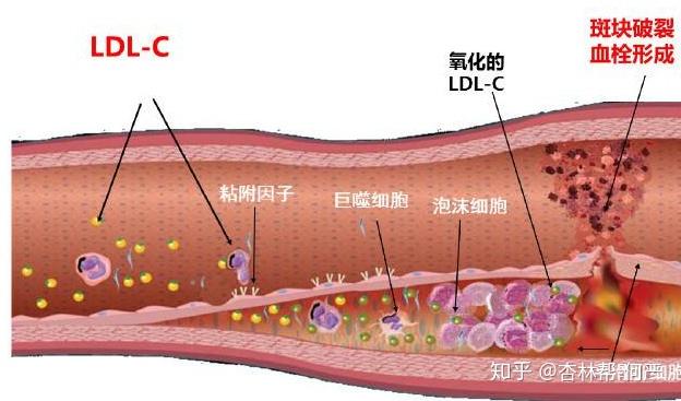 脂蛋白(vldl)或其残粒的方式侵入到动脉壁里, 而引起平滑肌细胞增生