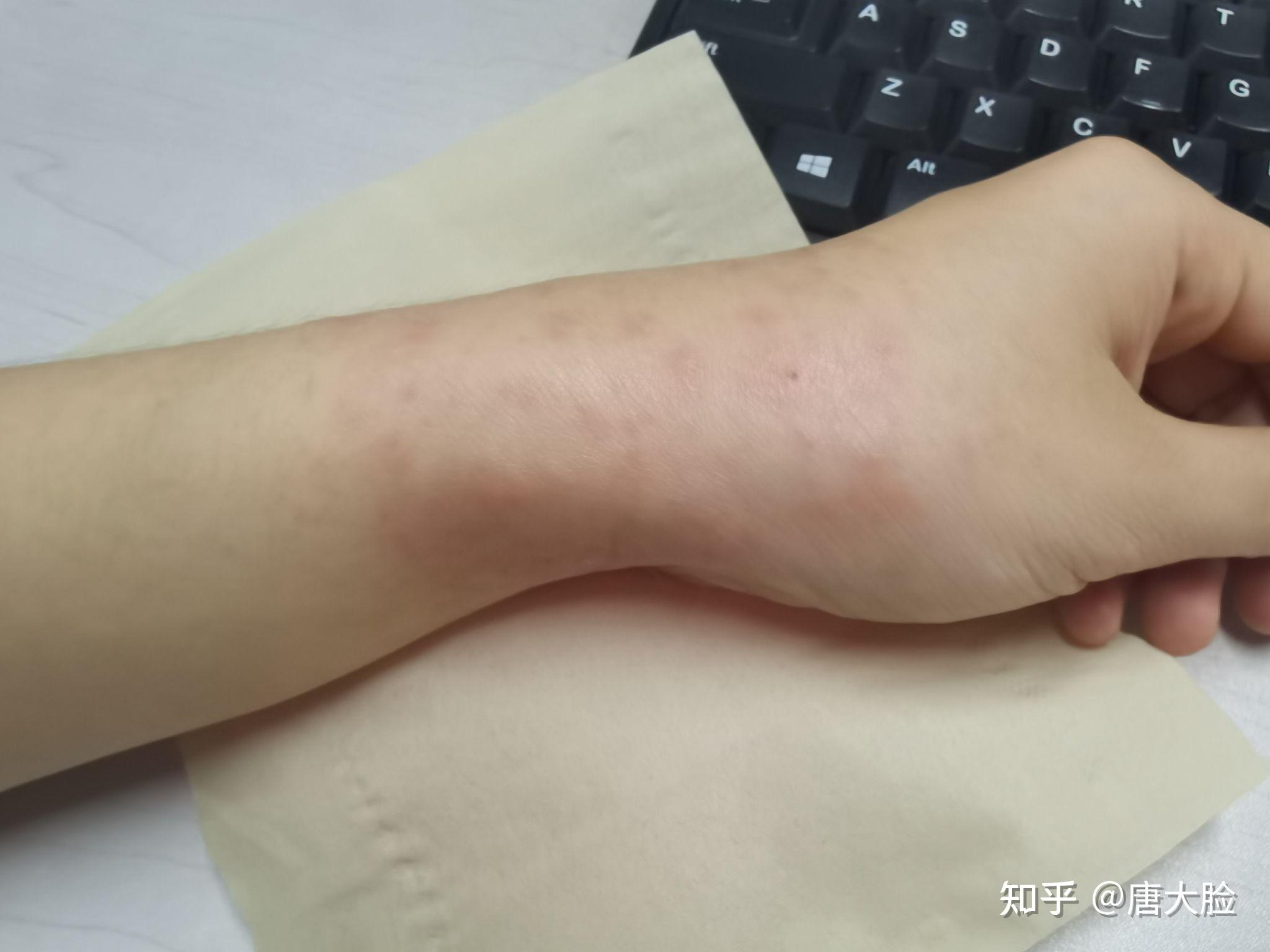4手腕腱鞘囊肿,在医院拿了膏药和红花油