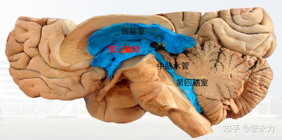 男子头痛不重视,竟查出罕见三脑室海绵状血管瘤