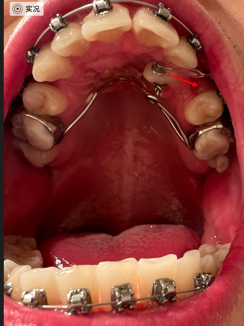 今天去複診,換了上排牙齒弓絲,給埋伏牙頰側粘了牽引的小釘,換了一種