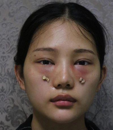 长沙内切去眼袋 眶隔释放 泪沟案例丨术后真实效果&感受分享