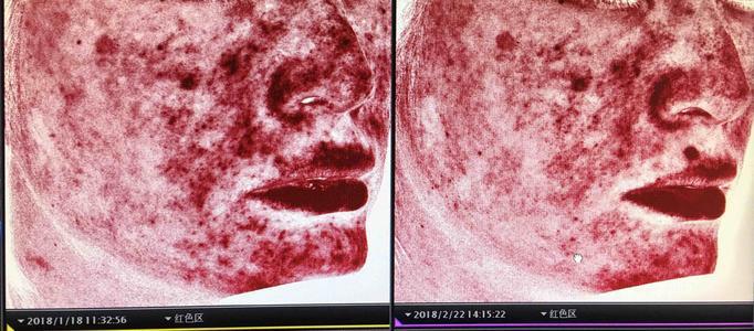 寻常痤疮vs玫瑰痤疮,还傻傻分不清楚? - 知乎