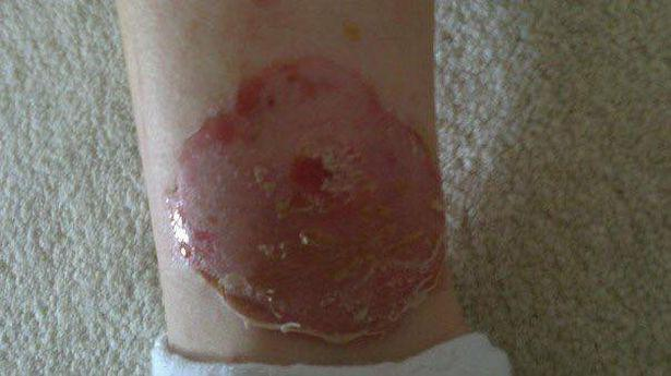 5)·虻叮咬,重口慎入 - 知乎