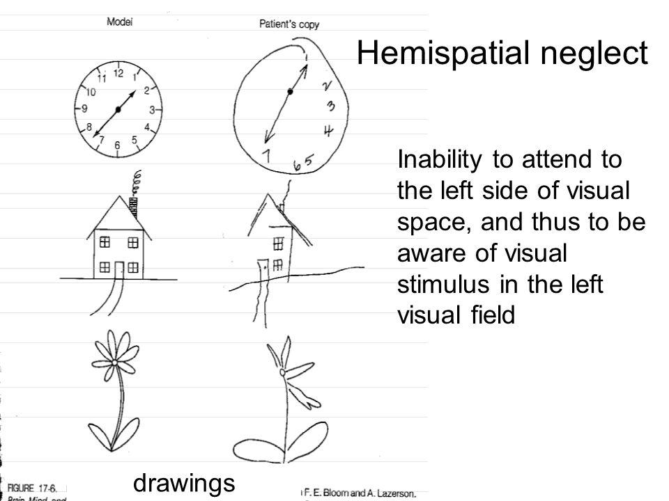 被嫌弃的左半边丨半侧空间忽略症患者的视野