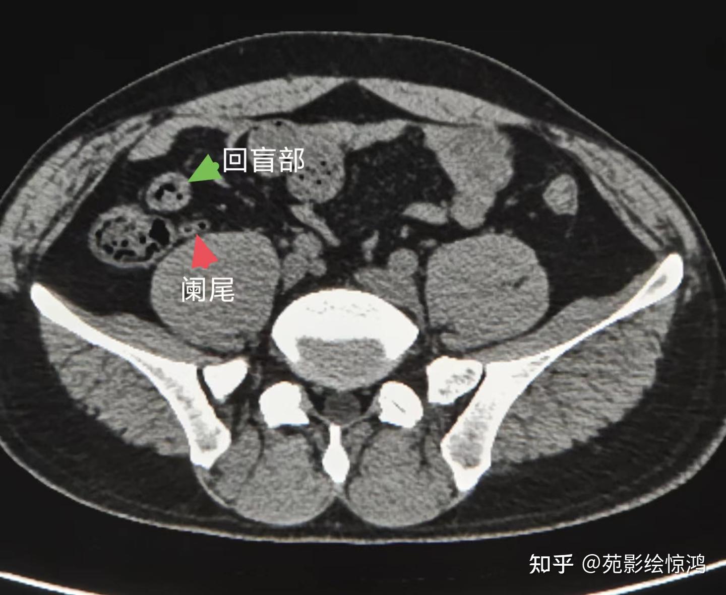 阑尾炎CT诊断 - 知乎