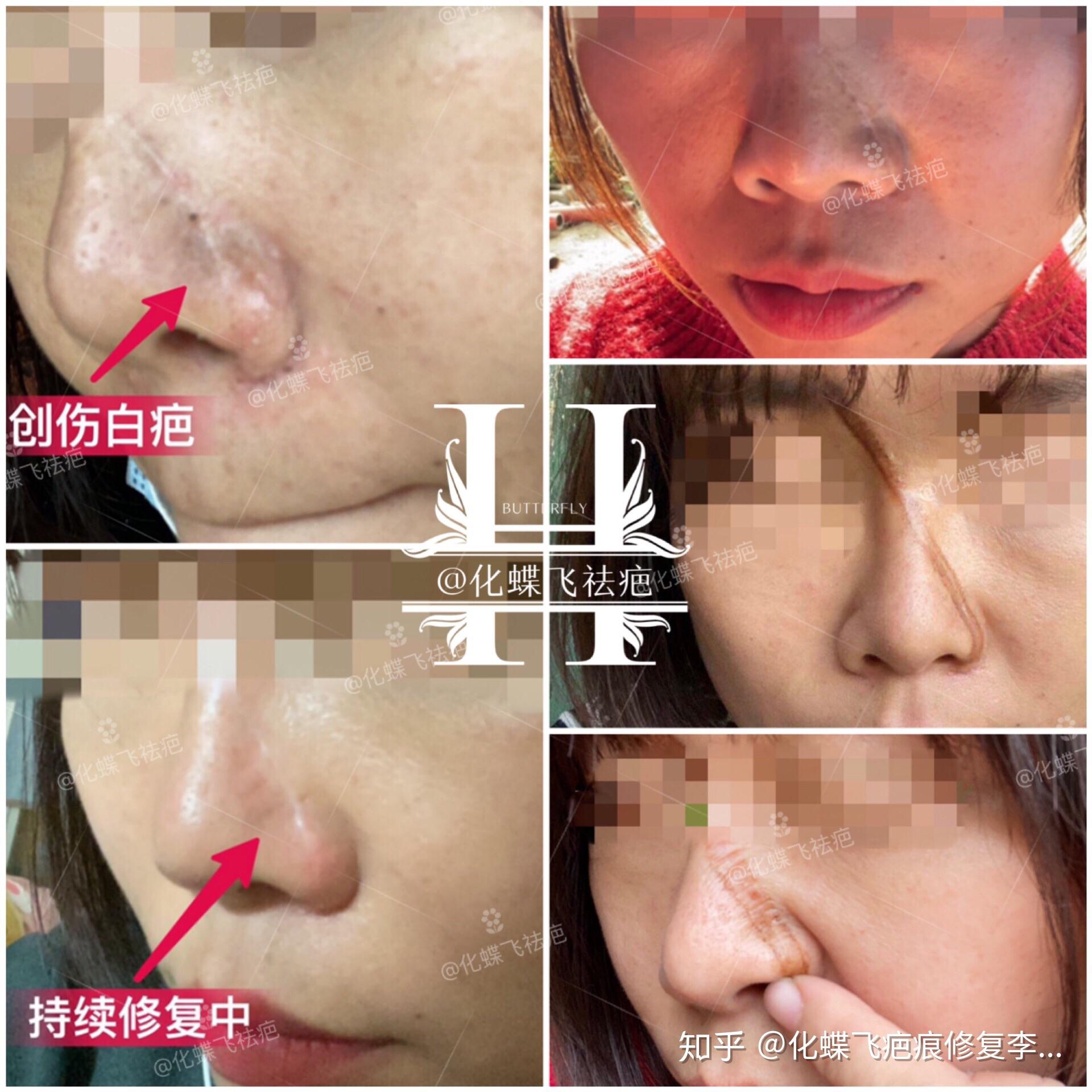 陈旧性划伤白色疤痕修复效果对比