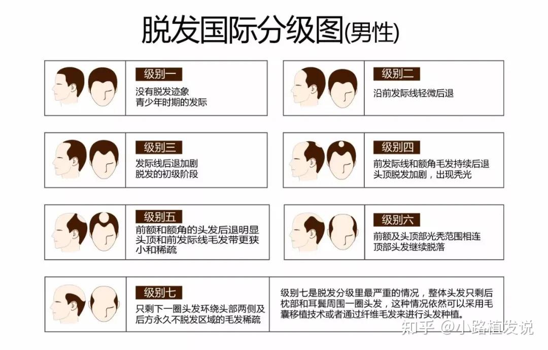 首先,男性雄激素性秃发的脱发程度分级目前多采用汉密尔顿分型